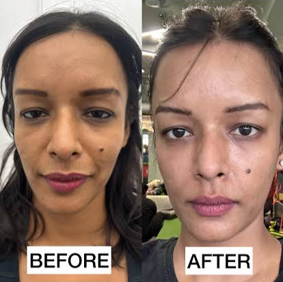 Healthy Skin Effect ( The Bombay Skin Clinic )